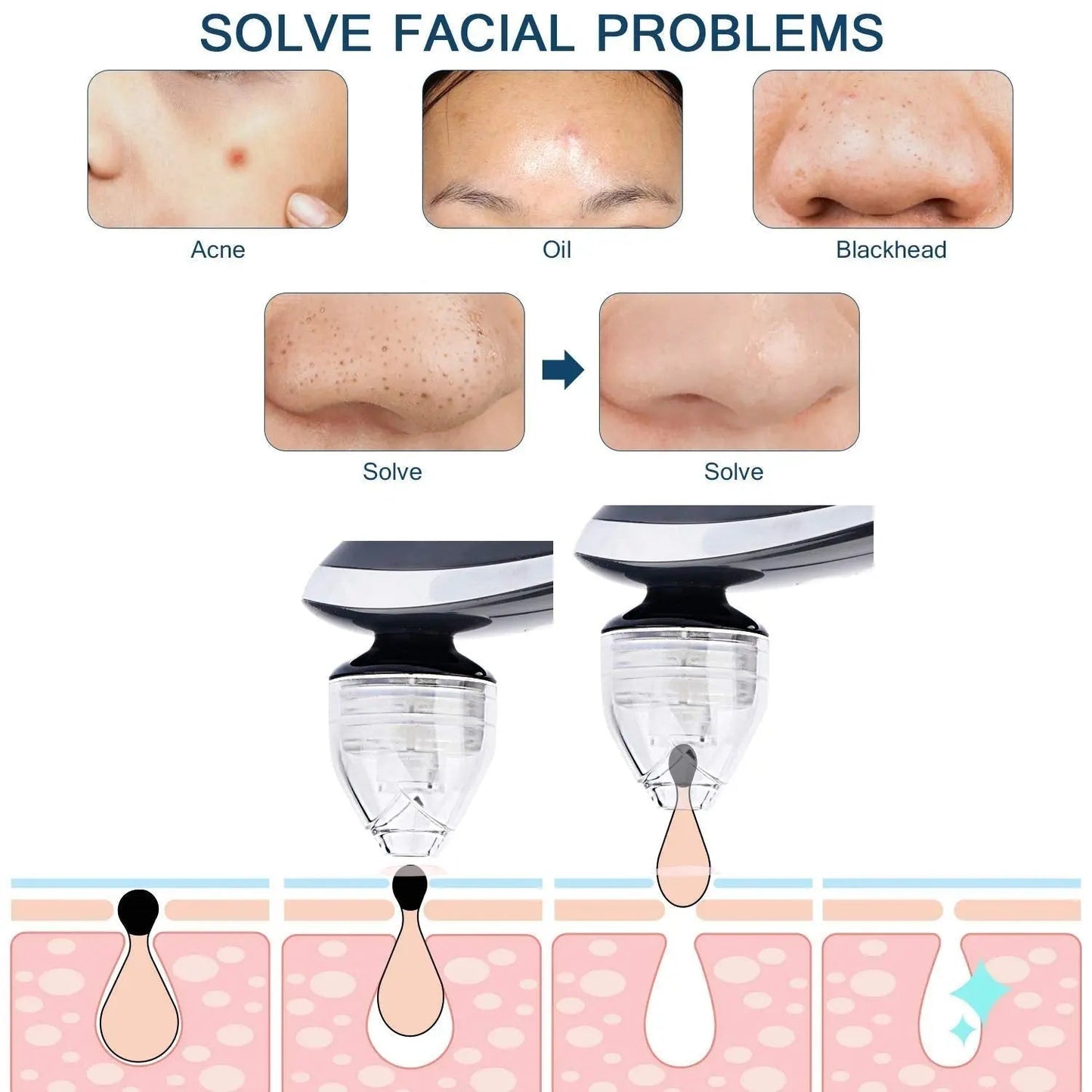 Blackhead Remover, TURATA Pore Cleanser Vacuum Kit (Black) - Galaxiee.com