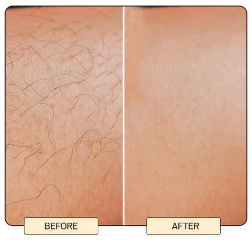 BabyVerse Professional IPL Laser Permanent Hair Removal - Galaxiee.comHair Removal